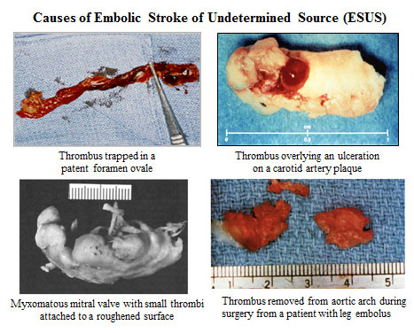 studies-esus-causes-of-embolic-stroke-of-undetermined-source